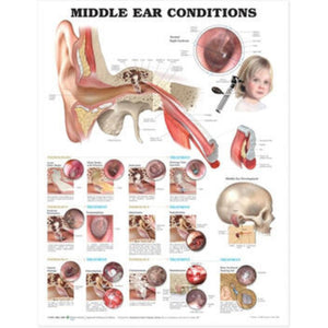Middle Ear Conditions Chart